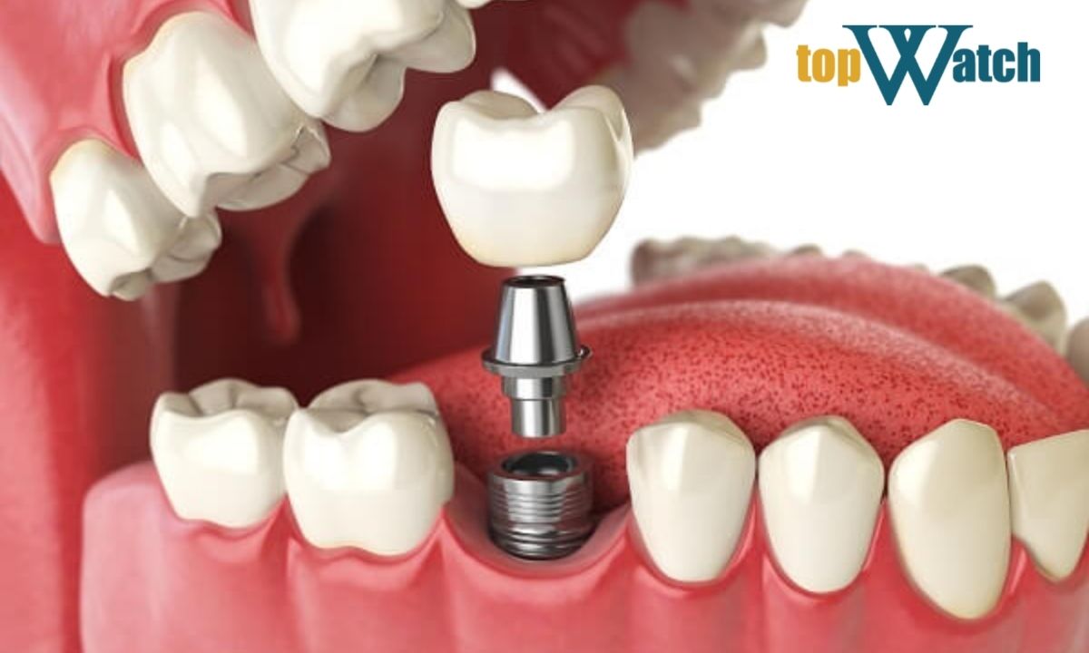 hợp kim titanium là gì